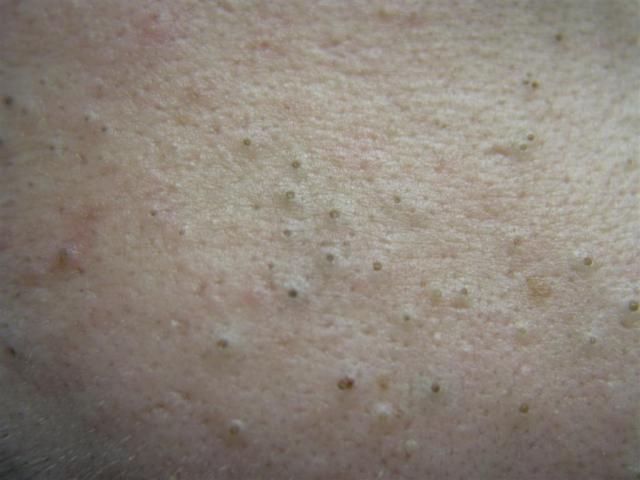 Blackheads