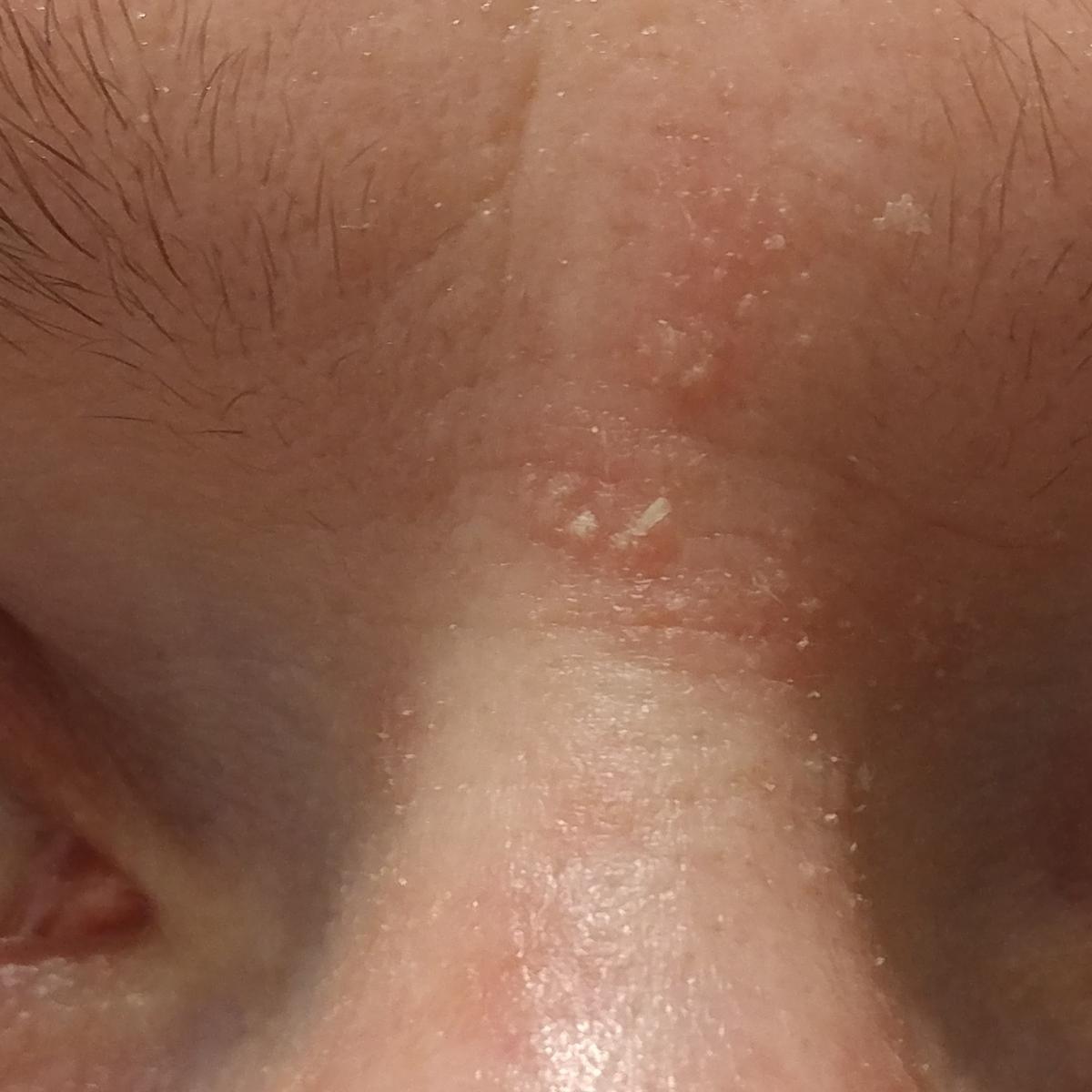 chronic inflammatory skin disorder