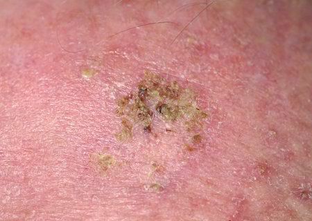 solar keratosis