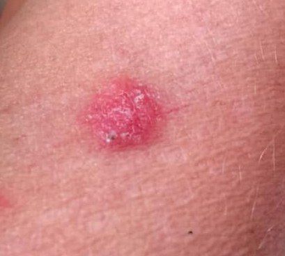 Basal cell carcinoma