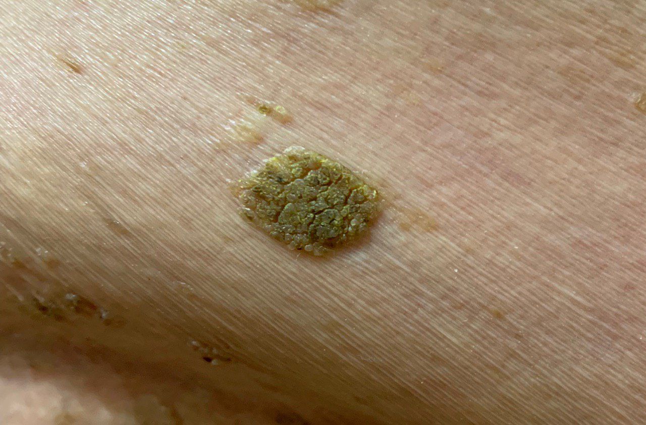 senile keratoma