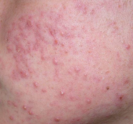Acne pustular