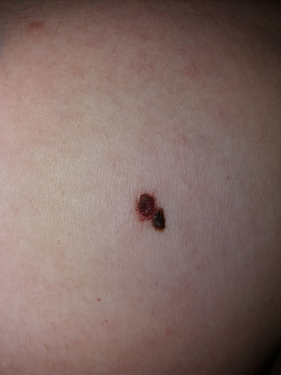 Melanoma