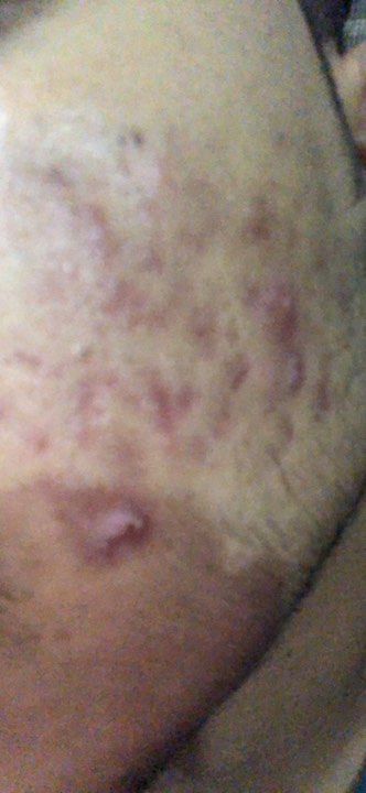 scars