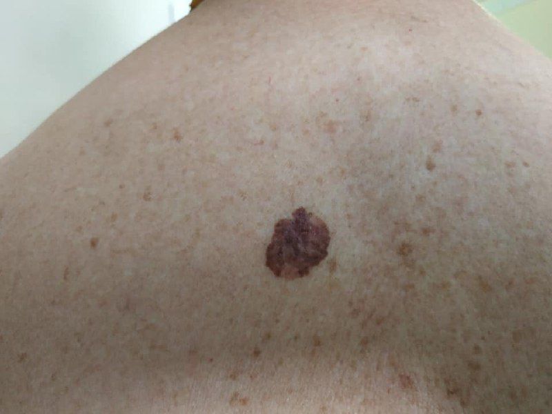 Lentigo Melanoma
