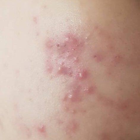 Acne pustular