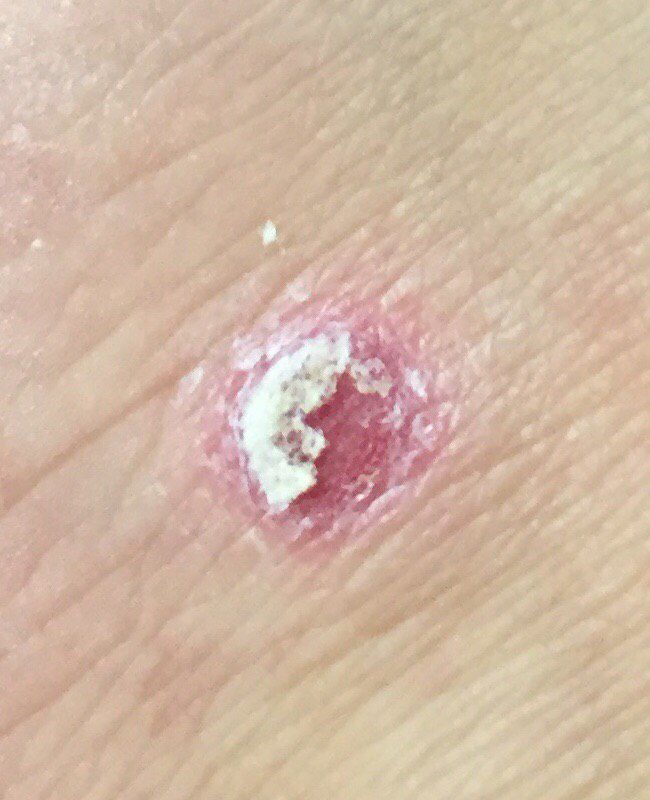 Squamous cell carcinoma