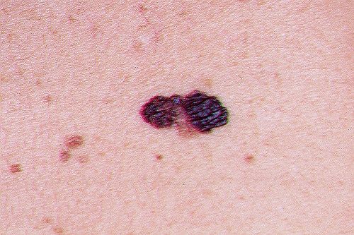 Melanoma