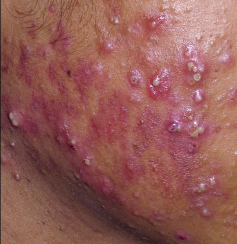 acne cystic