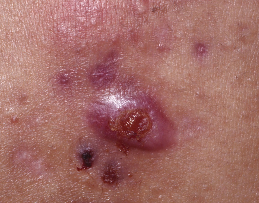 nodules