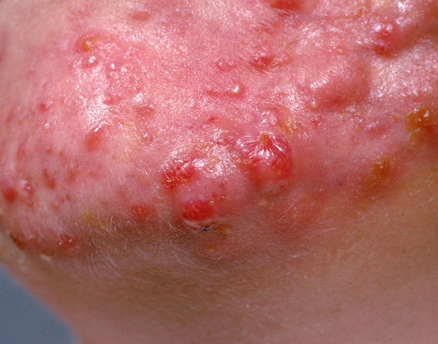 Acne Cystic