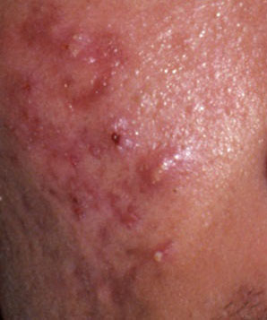 pustules