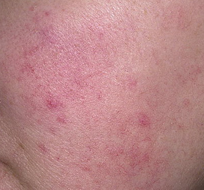 Rosacea