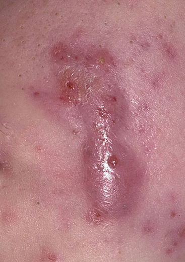 cysts