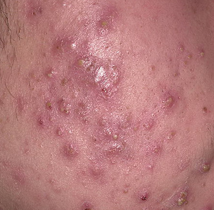 acne cystic