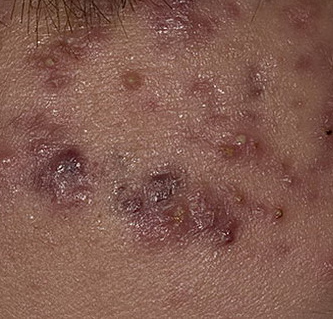 acne cystic