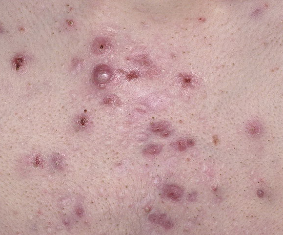 acne cystic