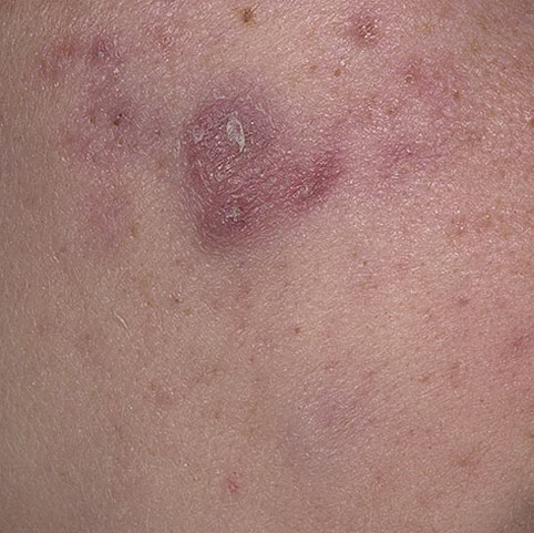 foci of hyperpigmentation