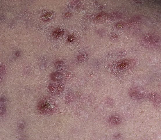 Cystic Acne