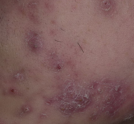 acne cystic
