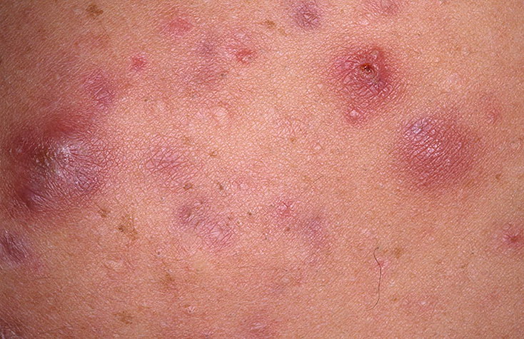 acne cystic