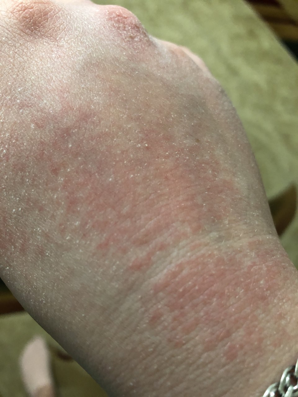atopic eczema