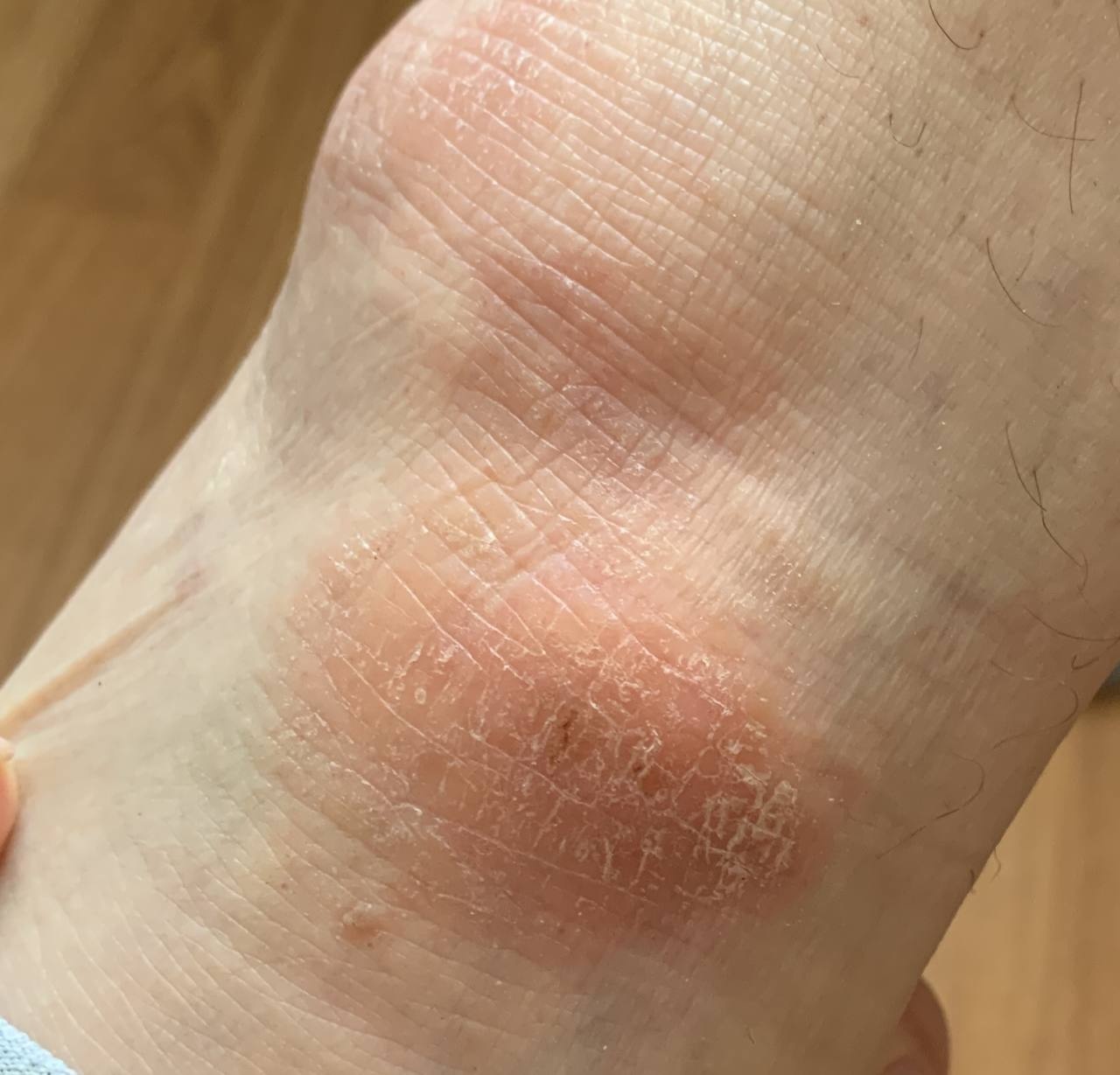 endogenous eczema