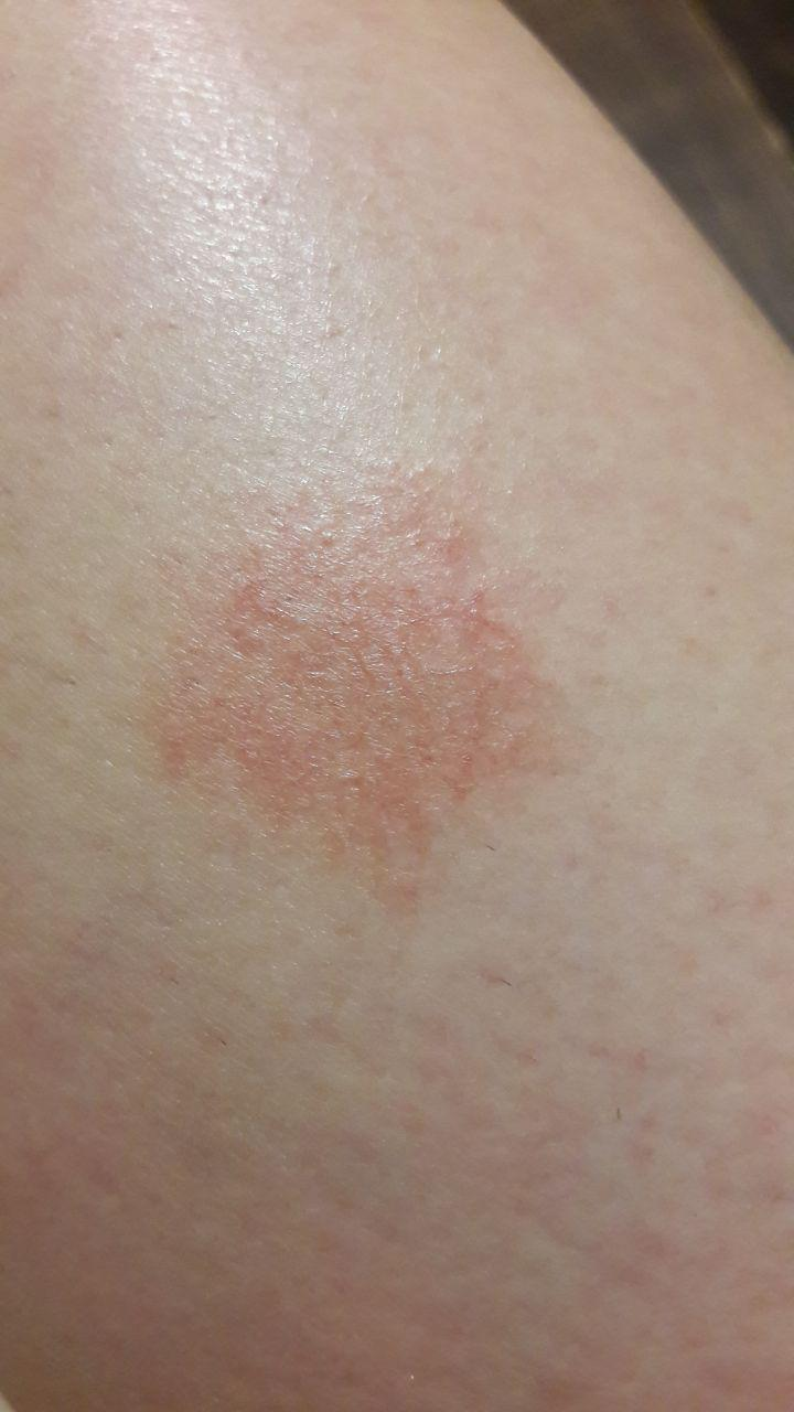 Dermatitis