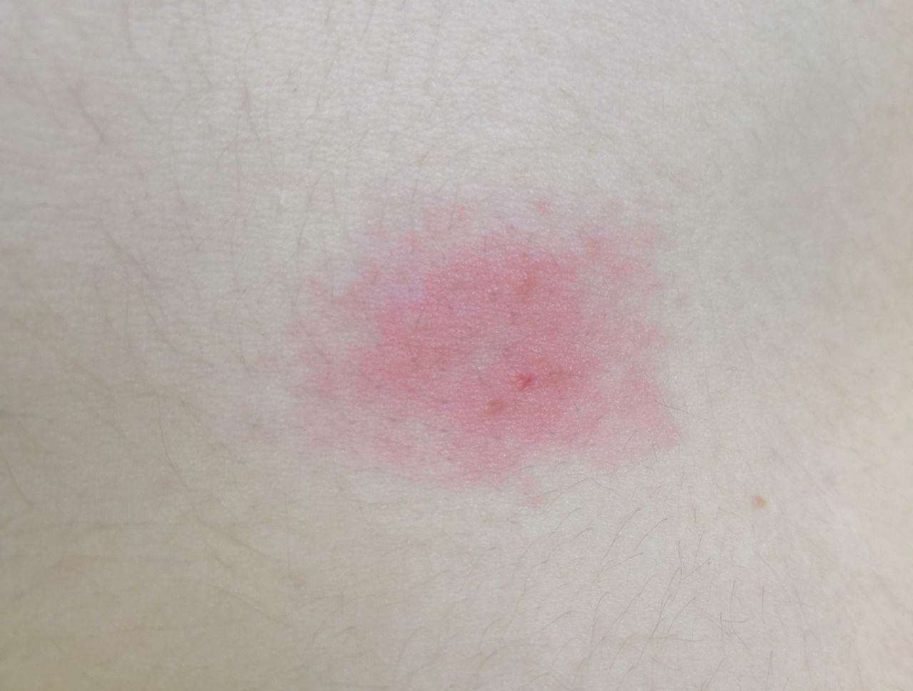 Dermatitis
