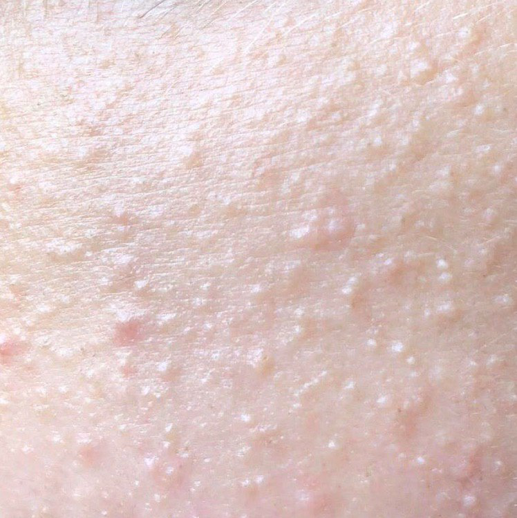 Milium