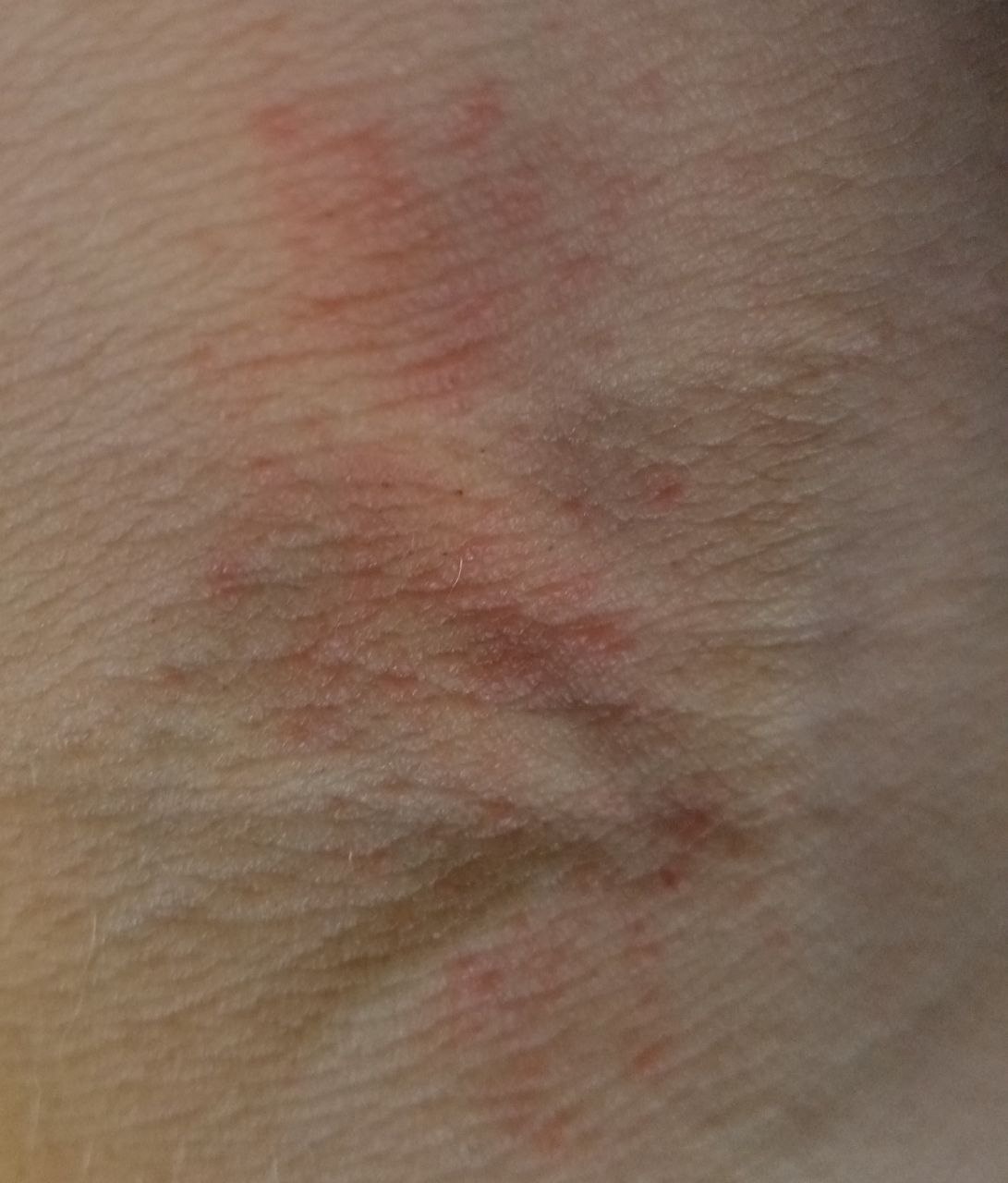 diffuse neurodermatitis